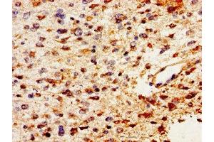 Immunohistochemistry of paraffin-embedded human glioma using ABIN7163691 at dilution of 1:100 (Pleiotrophin antibody  (AA 33-168))