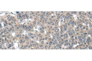 Immunohistochemistry of paraffin-embedded Human liver cancer tissue using CARD16 Polyclonal Antibody at dilution of 1:55(x200) (CARD16 antibody)