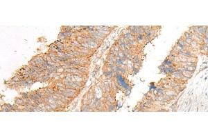 Immunohistochemistry of paraffin-embedded Human colorectal cancer tissue using GLIS1 Polyclonal Antibody at dilution of 1:50(x200) (GLIS1 antibody)
