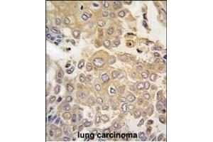 Forlin-fixed and paraffin-embedded hun lung carcino tissue reacted with PK4 antibody (N-term) (ABIN391465 and ABIN2837846) , which was peroxidase-conjugated to the secondary antibody, followed by DAB staining. (MAPK4 antibody  (N-Term))