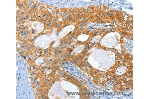 Immunohistochemistry of Human lung cancer using AMHR2 Polyclonal Antibody at dilution of 1:40 (AMHR2 antibody)