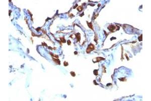 Immunohistochemical staining (Formalin-fixed paraffin-embedded sections) of human lung carcinoma with KRT8 monoclonal antibody, clone KRT8/803 . (KRT8 antibody)