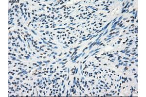 Immunohistochemical staining of paraffin-embedded Adenocarcinoma of colon tissue using anti-FRKmouse monoclonal antibody. (FRK antibody)
