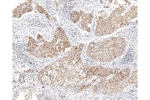 Immunohistochemistry analysis of paraffin-embedded human lung cancer using CYCS Polyclonal Antibody at dilution of 1:1000. (Cytochrome C antibody)