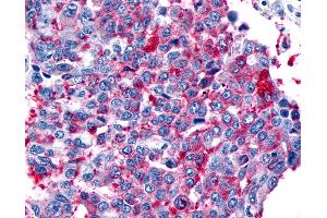 Anti-FZD8 / Frizzled 8 antibody IHC of human Lung, Non-Small Cell Carcinoma. (FZD8 antibody  (N-Term))