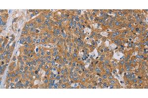 Immunohistochemistry of paraffin-embedded Human esophagus cancer using ACTN4 Polyclonal Antibody at dilution of 1:60 (alpha Actinin 4 antibody)