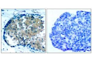 Immunohistochemical analysis of paraffin-embedded human breast carcinoma tissue, using Ezrin (phospho-Tyr353) antibody (E011063). (Ezrin antibody  (pTyr353))
