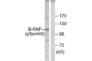 Immunohistochemistry analysis of paraffin-embedded human breast carcinoma tissue using B-RAF (Ab-446) antibody. (SNRPE antibody  (Ser446))
