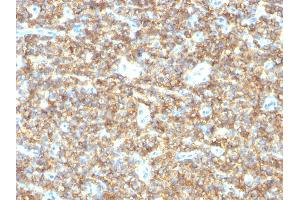 Formalin-fixed, paraffin-embedded human Ewing's Sarcoma stained with CD99 Mouse Monoclonal Antibody (HO36-1. (CD99 antibody)
