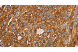 Immunohistochemistry of paraffin-embedded Human breast cancer using PAICS Polyclonal Antibody at dilution of 1:35 (PAICS antibody)