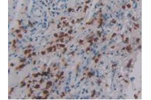 IHC-P analysis of Human Skin Cancer Tissue, with DAB staining. (DEFA4 antibody  (AA 23-97))