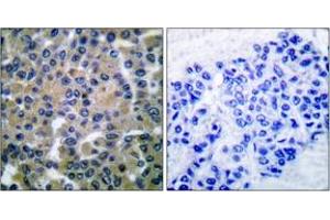 Immunohistochemistry analysis of paraffin-embedded human breast carcinoma tissue, using SYK (Ab-348) Antibody. (SYK antibody  (AA 314-363))