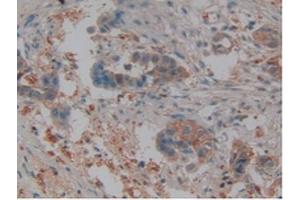 IHC-P analysis of Human Pancreas Cancer Tissue, with DAB staining. (Lipocalin 2 antibody  (AA 21-198))
