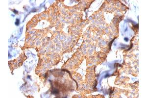Formalin-fixed, paraffin-embedded human Breast Carcinoma stained with HER-2 Mouse Monoclonal Antibody (SPM172). (ErbB2/Her2 antibody  (AA 311-462))