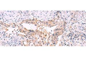 Immunohistochemistry of paraffin-embedded Human cervical cancer tissue using SLC12A5 Polyclonal Antibody at dilution of 1:40(x200) (KCC2 antibody)