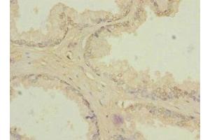 Immunohistochemistry of paraffin-embedded human prostate cancer using ABIN7176633 at dilution of 1:100 (ZIC3 antibody  (AA 1-240))