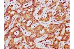 IHC image of ABIN7155027 diluted at 1:400 and staining in paraffin-embedded human liver cancer performed on a Leica BondTM system. (LIPC antibody  (AA 23-217))