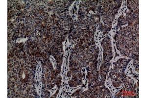 Immunohistochemistry (IHC) analysis of paraffin-embedded Human Breast Cancer, antibody was diluted at 1:100. (MCM3 antibody  (Internal Region))