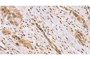 Immunohistochemistry of paraffin-embedded Human esophagus cancer using CENPV Polyclonal Antibody at dilution of 1:40 (CENPV antibody)