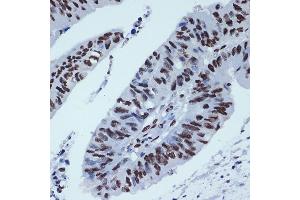 Immunohistochemistry of paraffin-embedded human colon carcinoma using ZBTB7A/FBI-1/LRF Rabbit mAb (ABIN7271439) at dilution of 1:100 (40x lens). (ZBTB7A antibody)