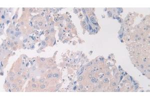 Detection of FLII in Human Breast cancer Tissue using Polyclonal Antibody to Flightless I Homolog (FLII) (FLII antibody  (AA 896-1176))