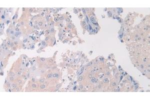 Detection of FLII in Human Breast cancer Tissue using Polyclonal Antibody to Flightless I Homolog (FLII) (FLII antibody  (AA 896-1176))