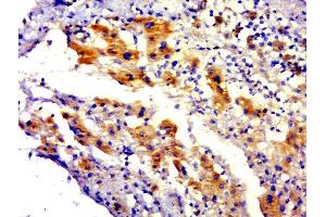 Paraformaldehyde-fixed, paraffin embedded human hepatocellular carcinoma tissue, Antigen retrieval by boiling in sodium citrate buffer(pH6) for 15min, Block endogenous peroxidase by 3% hydrogen peroxide for 30 minutes, Blocking buffer (normal goat serum) at 37°C for 20min, Antibody incubation with Rabbit Anti-C4orf51 Polyclonal Antibody, Unconjugated  at 1:500 overnight at 4°C, followed by a conjugated secondary and DAB staining (C4ORF51 antibody  (AA 1-100))