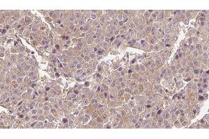 ABIN6276562 at 1/100 staining Human liver cancer tissue by IHC-P. (Glutamate Receptor 3 antibody)