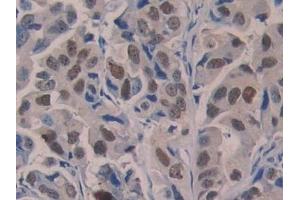 Detection of 5-LO in Human Breast cancer Tissue using Polyclonal Antibody to 5-Lipoxygenase (5-LO) (ALOX5 antibody  (AA 461-671))