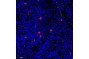 Immunofluorescence of paraffin embedded human endometrial cancer using CST9L (ABIN7073650) at dilution of 1:900 (300x lens) (CST9L antibody)