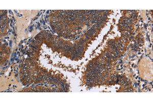 Immunohistochemistry of paraffin-embedded Human colon cancer tissue using LRRC57 Polyclonal Antibody at dilution 1:40 (LRRC57 antibody)
