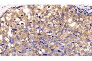 Detection of CTSK in Human Breast cancer Tissue using Polyclonal Antibody to Cathepsin K (CTSK) (Cathepsin K antibody  (AA 71-319))
