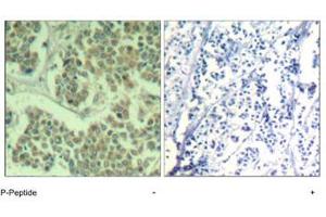 Immunohistochemical analysis of paraffin-embedded human breast carcinoma tissue using EIF2S1 (phospho S49) polyclonal antibody . (EIF2S1 antibody  (pSer49))