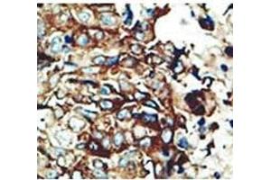 IHC testing of FFPE human breast cancer with PACSIN2 antibody at 1:50. (PACSIN2 antibody  (AA 342-371))