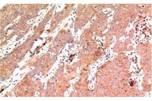 Immunohistochemistry of paraffin-embedded Human breast carcinoma tissue using Epsilon Tubulin Monoclonal Antibody at dilution of 1:200. (TUBE1 antibody)
