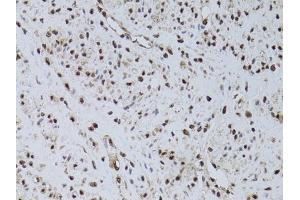 Immunohistochemistry of paraffin-embedded human uterine cancer using HUS1 antibody (ABIN6131776, ABIN6142084, ABIN6142086 and ABIN6218116) at dilution of 1:100 (40x lens). (HUS1 antibody  (AA 1-280))