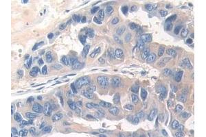 Detection of DOK3 in Human Breast cancer Tissue using Polyclonal Antibody to Docking Protein 3 (DOK3) (DOK3 antibody  (AA 128-385))