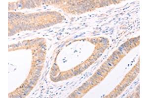 The image on the left is immunohistochemistry of paraffin-embedded Human colon cancer tissue using ABIN7131482(TRIM32 Antibody) at dilution 1/40, on the right is treated with fusion protein. (TRIM32 antibody)