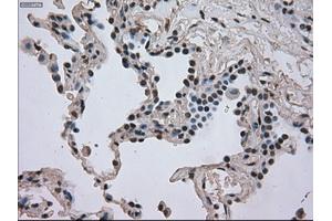 Immunohistochemical staining of paraffin-embedded Adenocarcinoma of breast tissue using anti-DHFR mouse monoclonal antibody.