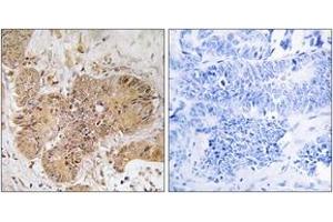 Immunohistochemistry analysis of paraffin-embedded human colon carcinoma tissue, using LUC7L2 Antibody. (LUC7L2 antibody  (AA 129-178))