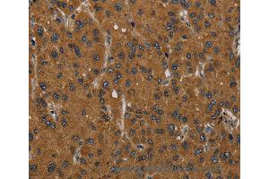 Immunohistochemistry of Human liver cancer using MIER2 Polyclonal Antibody at dilution of 1:60 (MIER2 antibody)