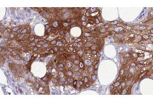 ABIN6277789 at 1/100 staining Human Head and neck cancer tissue by IHC-P. (SIX2 antibody  (Internal Region))