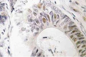 Immunohistochemistry (IHC) analyzes of Rad51 antibody in paraffin-embedded human colon carcinoma tissue. (RAD51 antibody)