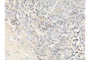 ABIN6259340 and ABIN6275456 at 1/100 staining human Hodgkin lymphoma by IHC-P. (RRAGA/B antibody  (C-Term))