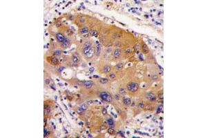 Formalin-fixed and paraffin-embedded human hepatocarcinoma tissue reacted with NNMT antibody , which was peroxidase-conjugated to the secondary antibody, followed by DAB staining. (NNMT antibody  (AA 77-106))