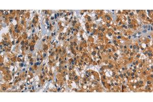 Immunohistochemistry of paraffin-embedded Human thyroid cancer using SMAD9 Polyclonal Antibody at dilution of 1:30 (SMAD9 antibody)
