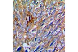 Immunohistochemical analysis of PAK1 staining in human prostate cancer formalin fixed paraffin embedded tissue section. (PAK1 antibody  (Center))