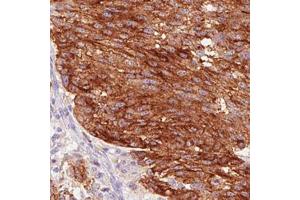 Immunohistochemical staining (Formalin-fixed paraffin-embedded sections) of human melanoma with STX7 monoclonal antibody, clone CL0257  shows strong cytoplasmic and membrane positivity in tumor cells. (Syntaxin 7 antibody)