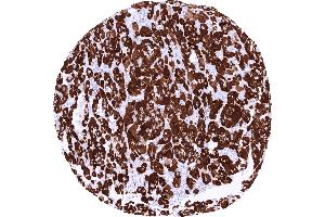 Adrenocortical carcinoma showing strong STAR immunostaining of tumor cells (Recombinant STAR antibody)