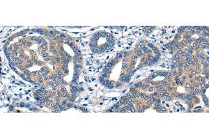 Immunohistochemistry of paraffin-embedded Human liver cancer tissue using MIIP Polyclonal Antibody at dilution of 1:45(x200) (MIIP antibody)